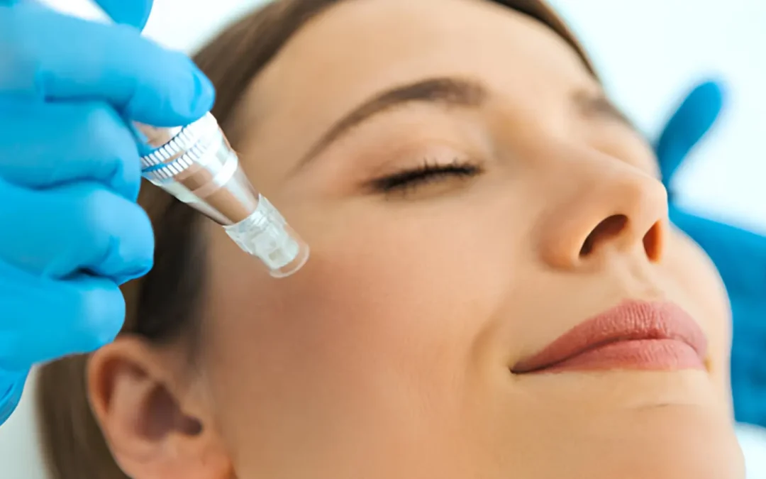 Discover Effective Skin Needling Treatment near South Melbourne