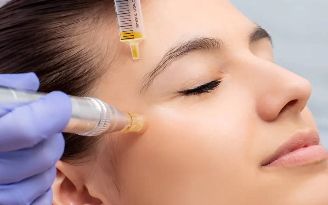 Professional Skin Needling Treatment in Southbank Melbourne
