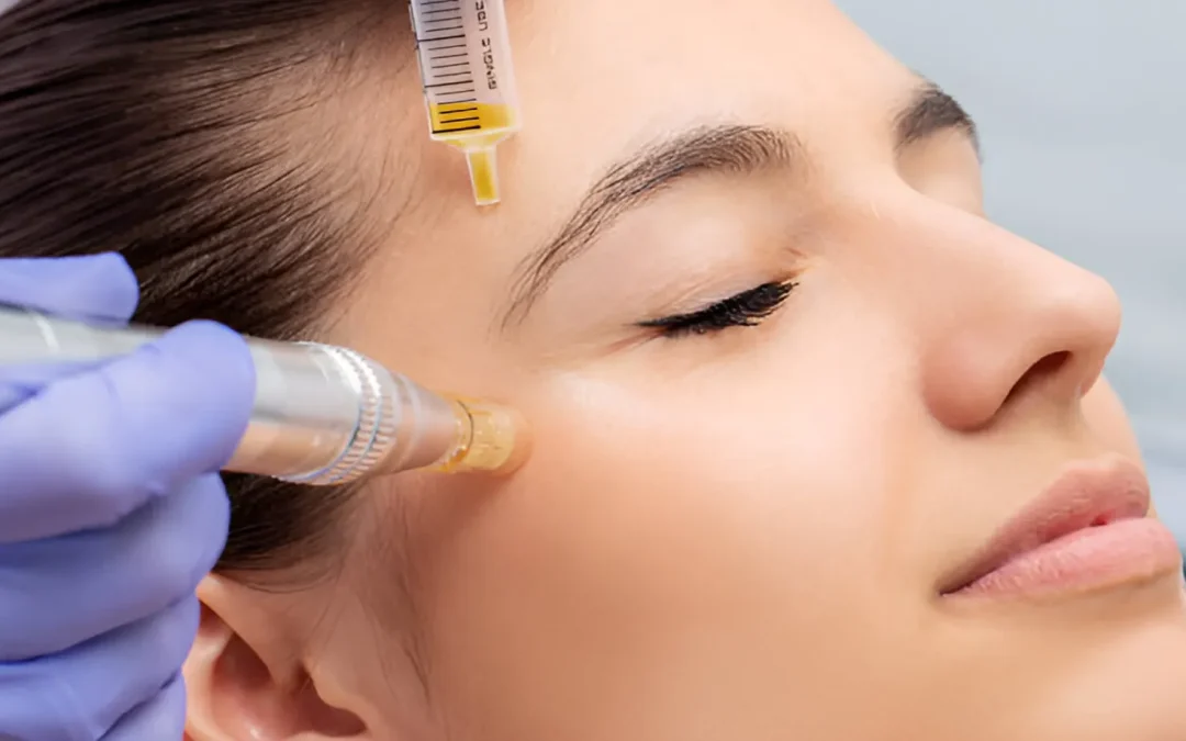 Best Skin Needling Treatment in Port Melbourne