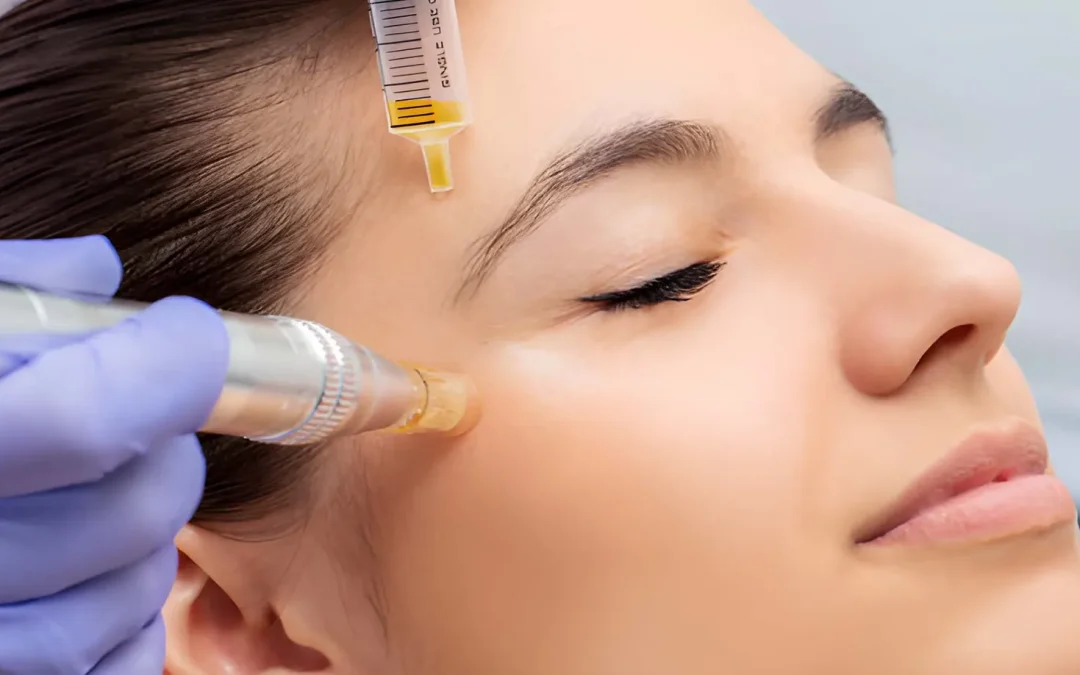 Best Skin Needling Treatment in Melbourne