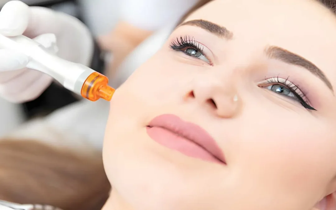 Best Skin Needling Treatment in Melbourne City
